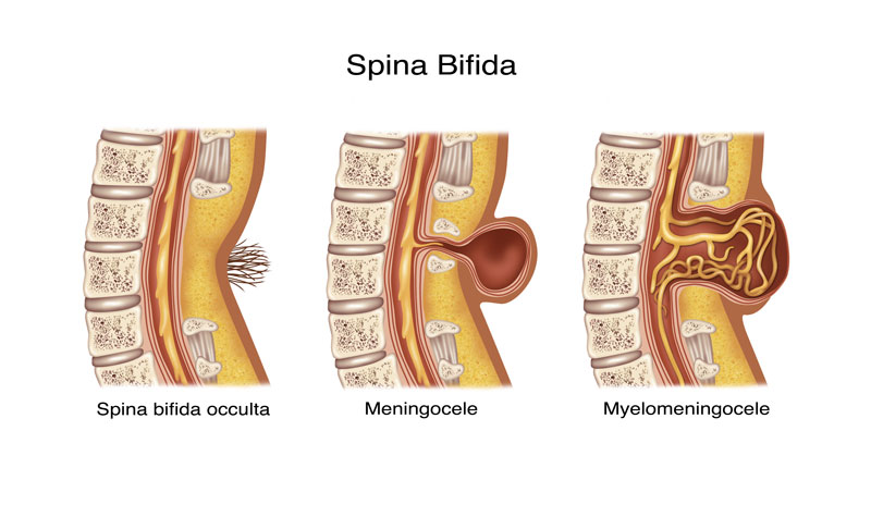 Spina Bifida spectrum medical illustration